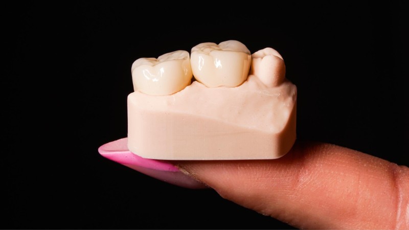 cementowanie stałych uzupełnień