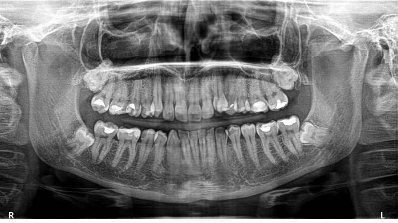Fot. 3. Diagnostyka obrazowa, RTG pantomograficzne przeglądowe, wykonane w dniu przyjęcia w Poradni Protetyki i Dysfunkcji Narządu Żucia; fot. archiwum autorów