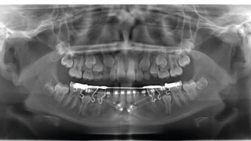 Ryc. 2. (a) Aparat stały do tymczasowego zakotwiczenia. (A) Główny element wspierający – łuk językowy z drutu SS 1,1 mm. (B) Prefabrykowane metalowe opaski z rurkami na pierwsze trzonowce żuchwy. (C) Pionowe haczyki z drutu SS 0,028”, z zagięciami w kierunku dystalnym; fot. archiwum autorów
