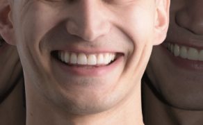 Fot. 7. Uśmiech pacjenta przed zabiegiem i po zabiegu; fot. archiwum autorów