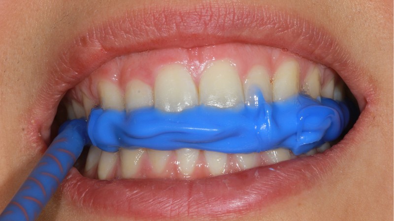 Fot. 4. Dołożenie masy LuxaBite w odcinkach bocznych – zgryz ustabilizowany w odcinku przednim; fot. archiwum autorów