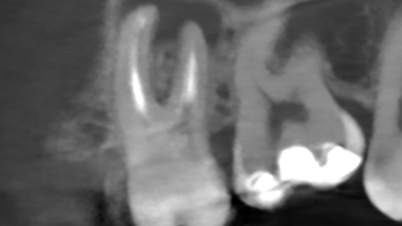Fot. 3. CBCT przed leczeniem, przedstawiające rozległość zmian w tkankach okołowierzchołkowych – projekcja czołowa; fot. archiwum autorów