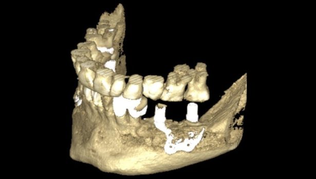 Indywidualny implant podokostnowy