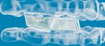 Mandibular Advancement