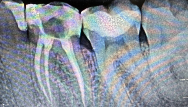 obliteracja