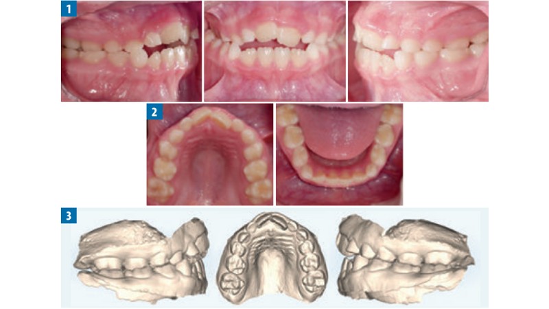 Leczenie obustronnego zgryzu krzyżowego