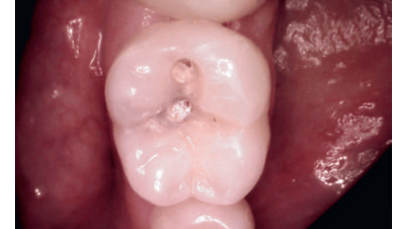 Fot. 2. Ząb 36 – próchnica