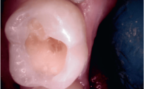 Fot. 8. Ząb 37 – opracowany