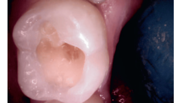 Fot. 8. Ząb 37 – opracowany