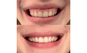 Fot. 3. U pacjentki wykonano iniekcje toksyny botulinowej w mm. dźwigacz wargi górnej, uzyskano zniwelowanie gummy smile