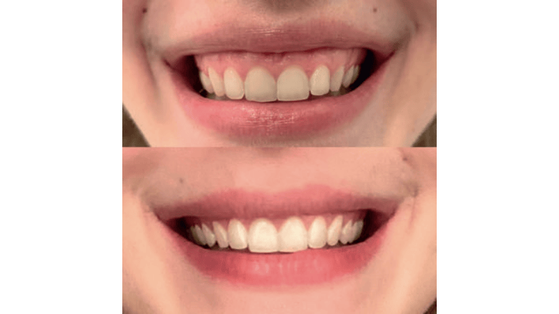 Fot. 3. U pacjentki wykonano iniekcje toksyny botulinowej w mm. dźwigacz wargi górnej, uzyskano zniwelowanie gummy smile