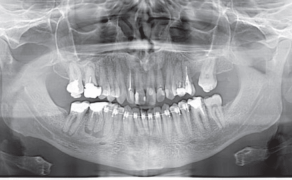 Fot. 1b. OPTG: przy wierzchołkach korzeni widoczne ogniska osteolityczne, nieostro odgraniczone od otaczającej kości, z patologiczną resorpcją cementu