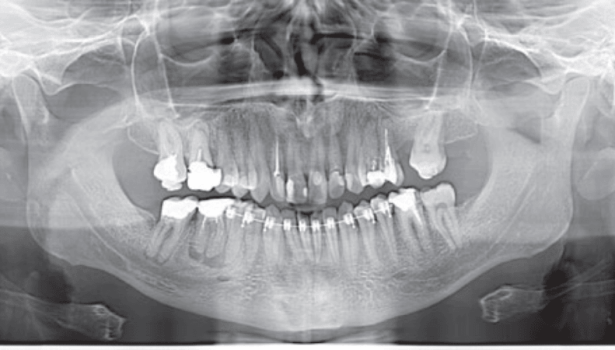 Fot. 1b. OPTG: przy wierzchołkach korzeni widoczne ogniska osteolityczne, nieostro odgraniczone od otaczającej kości, z patologiczną resorpcją cementu