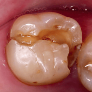 Zaopatrzenie zębodołu poekstrakcyjnego laserami dużej mocy