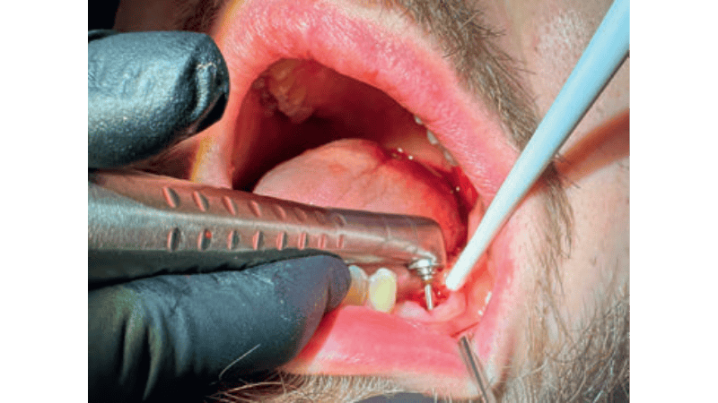 Zaopatrzenie zębodołu poekstrakcyjnego laserami dużej mocy