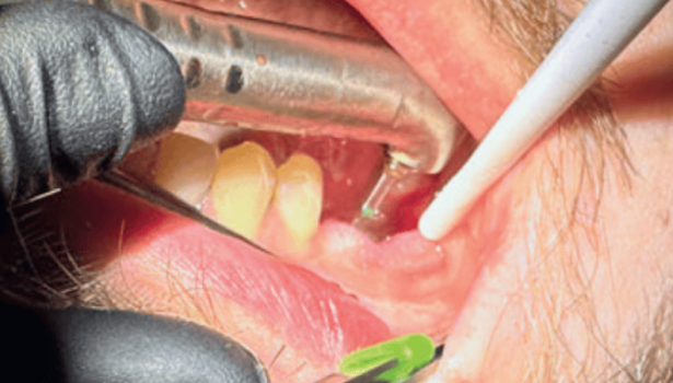 Zaopatrzenie zębodołu poekstrakcyjnego laserami dużej mocy i za pomocą fotobiomodulacji