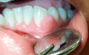 Fot. 4. Nadziąślak o etiologii urazowej. Z wywiadu – uraz nicią dentystyczną