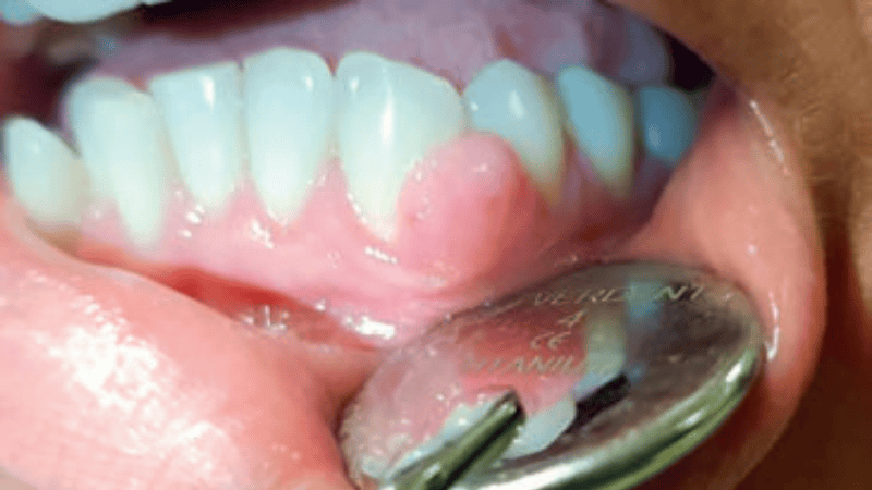 Fot. 4. Nadziąślak o etiologii urazowej. Z wywiadu – uraz nicią dentystyczną