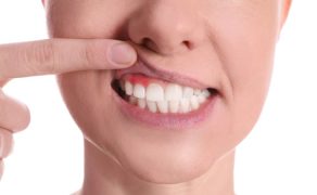 paradontoza; fot. iStock