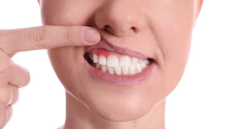 paradontoza; fot. iStock