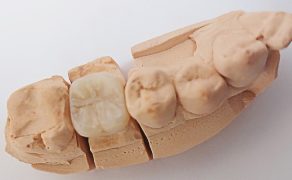 odbudowa zębów po leczeniu endodontycznym