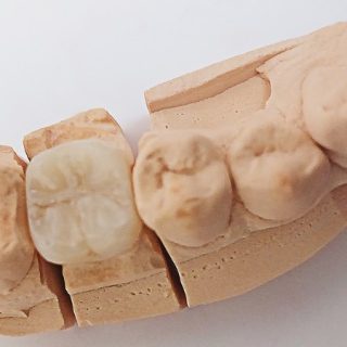 odbudowa zębów po leczeniu endodontycznym
