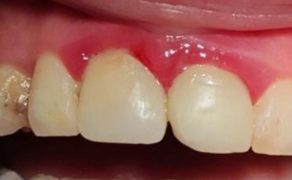 Fot. 8. Czynnik predysponujący w postaci nawisającej odbudowy kompozytowej zęba 11 oraz 21