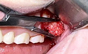 Fot. 6. Usunięcie zmiany