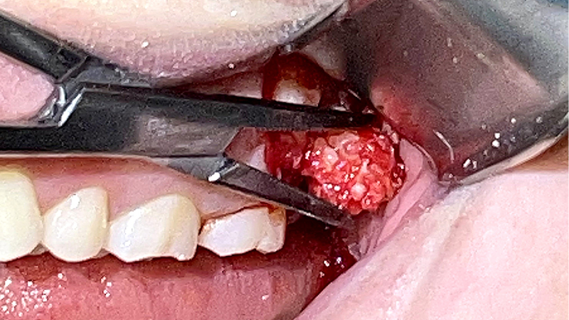 Fot. 6. Usunięcie zmiany