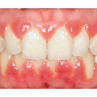 Leczenie powiększenia dziąseł