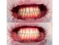 Fot. 5. Wybielanie zębów oraz korekta estetyczna d. 13-23 wykonana w celu zamknięcia diastemy i trem w odcinku przednim (praca własna)