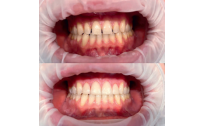 Fot. 5. Wybielanie zębów oraz korekta estetyczna d. 13-23 wykonana w celu zamknięcia diastemy i trem w odcinku przednim (praca własna)