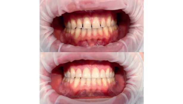 Fot. 5. Wybielanie zębów oraz korekta estetyczna d. 13-23 wykonana w celu zamknięcia diastemy i trem w odcinku przednim (praca własna)