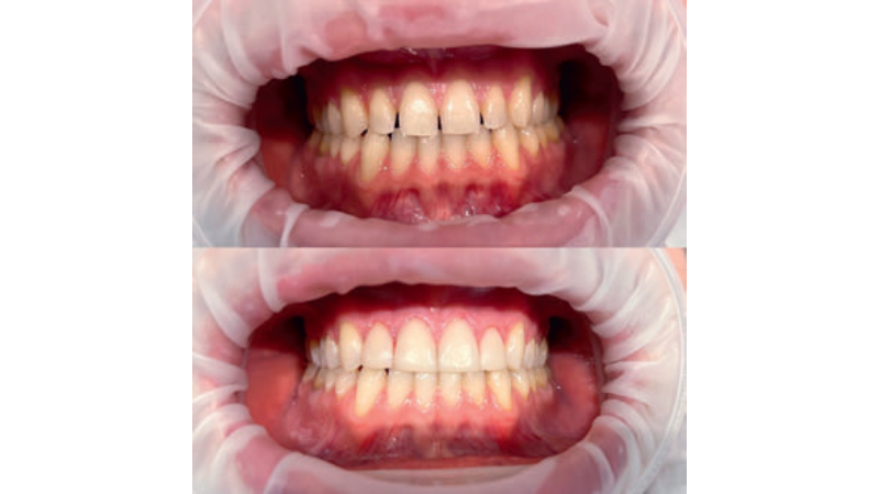 Fot. 5. Wybielanie zębów oraz korekta estetyczna d. 13-23 wykonana w celu zamknięcia diastemy i trem w odcinku przednim (praca własna)