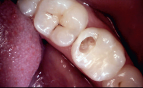 Fot. 4. Przypadek 2 – otwarty ubytek próchnicowy