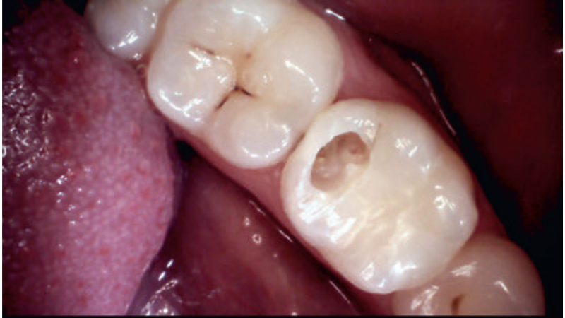 Fot. 4. Przypadek 2 – otwarty ubytek próchnicowy