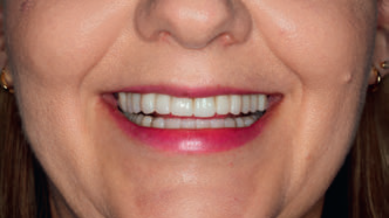 Fot. 6. Pacjent trzeci – efekt końcowy