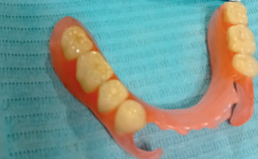 Fot. 3. Proteza akronowa uzupełniająca braki skrzydłowe dolne