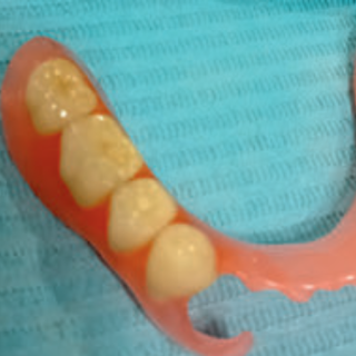 Fot. 3. Proteza akronowa uzupełniająca braki skrzydłowe dolne