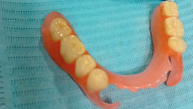 Fot. 3. Proteza akronowa uzupełniająca braki skrzydłowe dolne