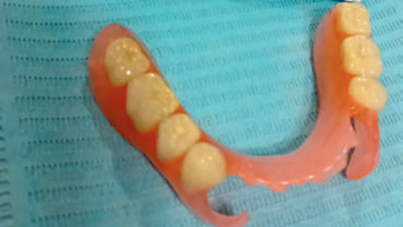 Fot. 3. Proteza akronowa uzupełniająca braki skrzydłowe dolne