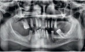Fot. 1. Zdjęcie pantomograficzne przed leczeniem protetycznym
