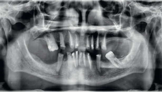 Fot. 1. Zdjęcie pantomograficzne przed leczeniem protetycznym
