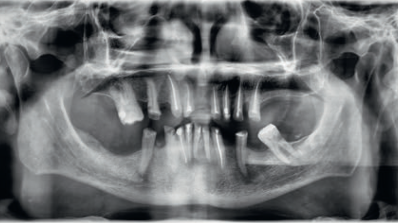Fot. 1. Zdjęcie pantomograficzne przed leczeniem protetycznym