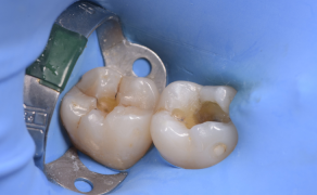 Fot. 2. Sytuacja po usunięciu wypełnień amalgamatowych