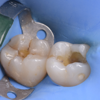 Fot. 2. Sytuacja po usunięciu wypełnień amalgamatowych