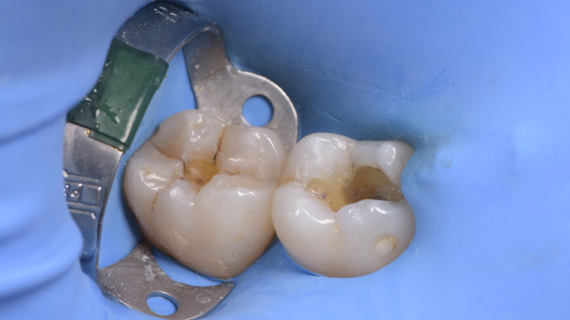 Fot. 2. Sytuacja po usunięciu wypełnień amalgamatowych