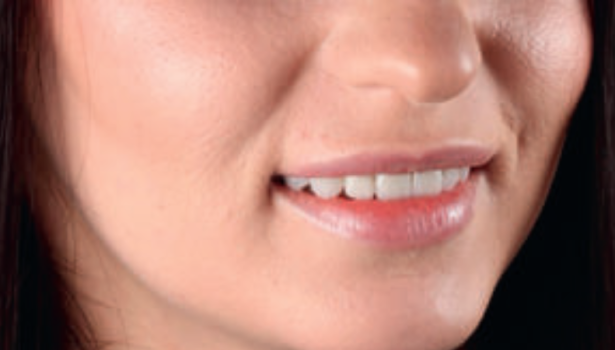 Fot. 12c. Stan po siedmiu dniach od oddania uzupełnień protetycznych