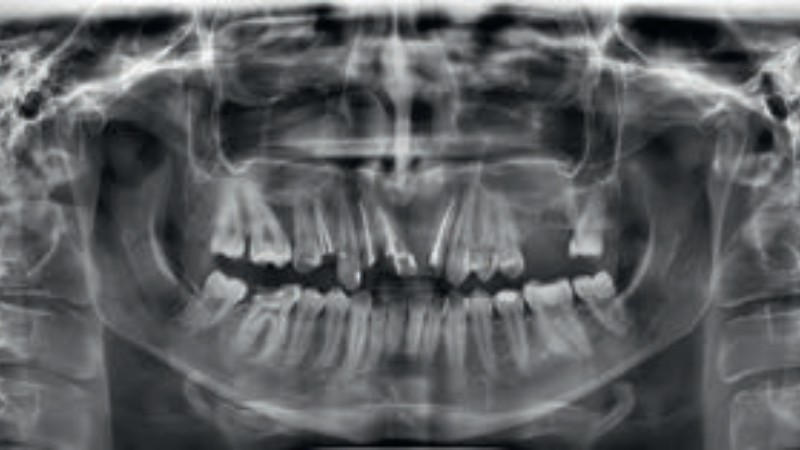 Fot. 1e. OPG przed leczeniem