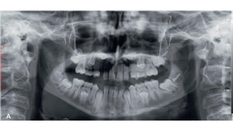 Fot. 1a. Badanie radiologiczne przed leczeniem: a) OPG przed leczeniem; b) przekrój CBCT w płaszczyźnie poziomej; c) przekrój CBCT w płaszczyźnie strzałkowej; d) cefalogram przed leczeniem; e) analiza cefalogramu wykonanego przed leczeniem